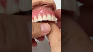 Removable denture [upl. by Eilraep]