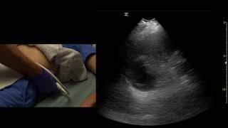 Left Upper Quadrant Abdomen Coronal Views Ultrasound Scanning Techniques [upl. by Lzeil]