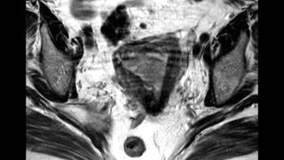 Endometrial Cancer with 50 myometrial invasion [upl. by Alih]