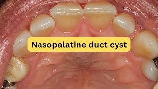 What is nasopalatine duct cyst EASY [upl. by Risser]