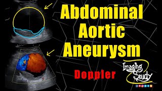 Abdominal Aortic Aneurysm  Ultrasound  Doppler  Case 291 [upl. by Lowenstern962]