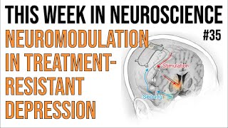 TWiN 35 Neuromodulation in treatmentresistant depression [upl. by Mairam810]