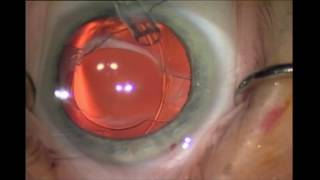 CCS in hingedbased accommodative intraocular lenses  Video S1 [upl. by Lawlor]