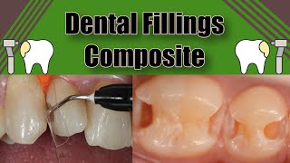 How To Do Dental Fillings  Tooth Colored Composite  2 Point View [upl. by Ennylcaj498]