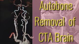 Autobone removal of CTA Brain with imaging software [upl. by Ecirtnom]