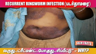 Repeated Ringworm infection  reason Facts from Dermatologist  Dr Pallavi Dhanyan [upl. by Attiuqaj623]