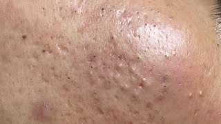 ACNE TREATMENT VU QUYNH MI  Blackheads Chin amp Nose Of Tweens 2024 EX [upl. by Rasec426]