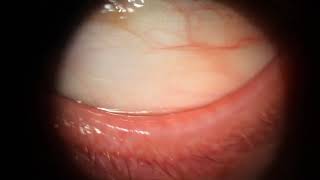 Severe Meibomian Gland Disease Expression day 7 [upl. by Kalb]