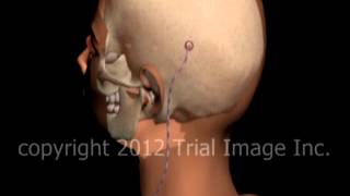 Hydrocephalus shunt video by Dr Cal Shipley MD [upl. by Eekram]