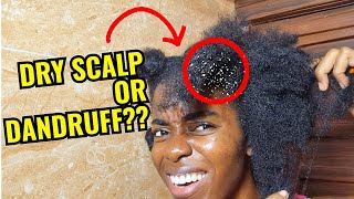 DANDRUFF vs DRY SCALP What is the DIFFERENCE dryscalpremedy dryscalp naturalhair dandruff [upl. by Tandy]