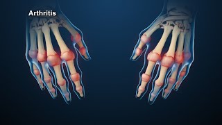 Rheumatoid Arthritis Animation [upl. by Aciretahs]