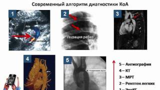 Коарктация аорты симптомы диагностика лечение [upl. by Stacy]