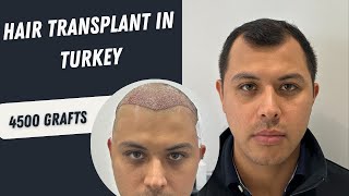 Hair Transplant in Turkey  Hair Transplant 4500 Grafts Process  Hair Transplant hairtransplant [upl. by Oag]