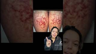 Erythema Ab Igne Beware skincare dermatology spaceheaters [upl. by Adiasteb367]