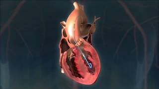 Impella  Eternal Hospital  Worlds Smallest Heart Pump [upl. by Zirkle531]