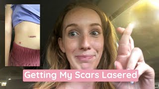 Scar Laser Treatment My Precancerous Mole Scar Removal [upl. by Emiaj]