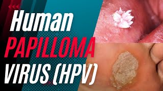 Human Papilloma Virus HPV  Signs Symptoms Causes treatment and Can it be Cured [upl. by Fisoi854]