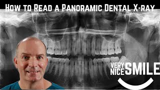 How to read a panoramic dental x ray [upl. by Llenrac]