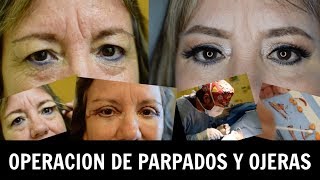 Cómo es la operación de párpados y ojeras  Ana Mireles [upl. by Pournaras]