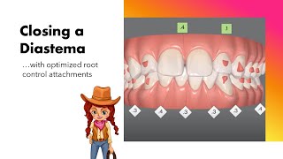 Invisalign ClinCheck  Closing a diastema with root control attachments [upl. by Devine]