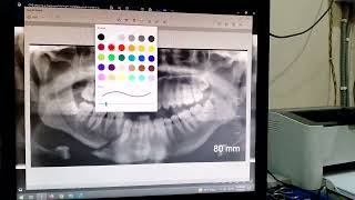 How to easily about for opg xray fracture [upl. by Donielle]