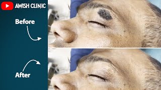 SEBORRHEIC KERATOSIS TREATMENT  Skin Horn सींग removal  By Dr Vijay Kumar [upl. by Ennaeirb]