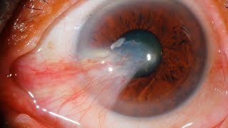 Pterygium Uncovering Causes and Symptomseyedoctor [upl. by Aisor586]