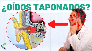 ¿OÍDOS TAPONADOS 🙉 Remedio natural para eliminar el tapón👂 [upl. by Stephania791]