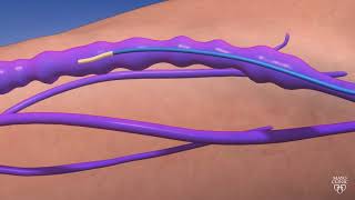 Guiding Light An Animated Journey through Endovenous Thermal Ablation [upl. by Etnuahc]