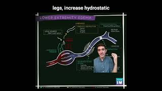 35 Lower Extremity Swelling How does changes in hydrostatic pressure cause lower extremity edema [upl. by Keligot624]