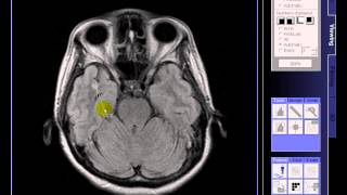 BRAIN MRI Multiple lacunar infarcts [upl. by Lyrret]