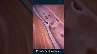 Deep Vein Thrombosis  DVT  medical short video  deep veins [upl. by Khudari409]