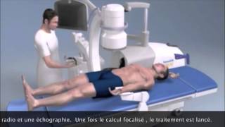 Lithotripsie extra corporelle  Extracorporeal Shock Wave Lithotripsy Montpellier [upl. by Annayr]