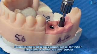 IMPRESION DIGITAL CON ESCANER INTRAORAL DE VARIOS IMPLANTES UTILIZANDO UN SOLO BODYSCAN [upl. by Esirehc]