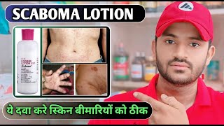 Scaboma lotion uses dose benefits and Side effects full review in hindi [upl. by Yhtir]