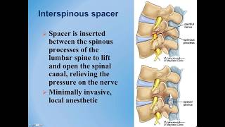 Lumbar Spinal Stenosis  Diagnosis and Treatment Options [upl. by Ahcrop]