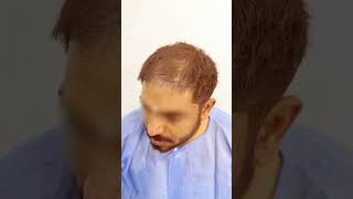 Incredible Hair Transplant Before amp After Dr Amit Kerure Hair Transplant Clinic Navi Mumbai [upl. by Stavro]