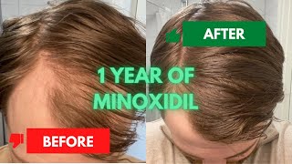 1 Year of Using Minoxidil  My Hair Growth Journey  Before amp After Results [upl. by Gentille]