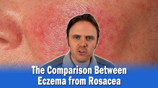 The Comparison Between Eczema from Rosacea [upl. by Aria]