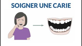 Comment soigner une dent cariée [upl. by Shena]