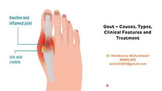 Gout  Types Clinical Features and Treatment  Hyperuricemia  Uric Acid  Biochemistry [upl. by Uria]