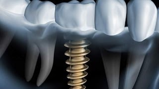 Welches Zahnimplantat System ist das beste [upl. by Lehteb488]