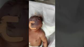 anencephaly  Anencephaly is a serious birth defect ytshorts nicu youtubefeeds medicalstudent [upl. by Sevy149]