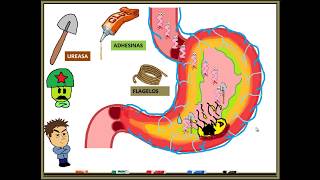 HELICOBACTER PYLORI GASTRITIS [upl. by Wallie]