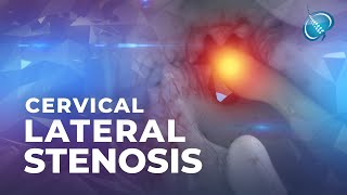 What is Cervical Lateral Stenosis  Foraminal Stenosis [upl. by Nellie]