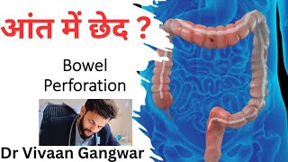 Bowel Perforation  Intestinal Perforations  Bowel Perforation Causes  Intestinal Obstruction [upl. by Garrott]