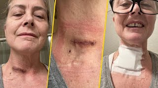 What happened to Sue Aikens Neck Surgery amp Health Updates [upl. by Nicolette959]