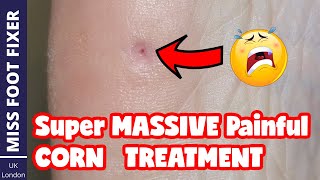 Super Massive Painful Deep Corn Removal  Deep Corn  Full Treatment By Miss Foot Fixer [upl. by Posehn]