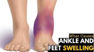 What Causes Ankles amp Feet Swelling  Diagnosis amp Treatment [upl. by Ihcalam248]