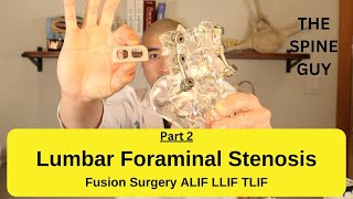 Lumbar Foraminal Stenosis  Fusion Surgery Options Part 2 [upl. by Yaf]